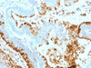 Formalin-fixed, paraffin-embedded human colon carcinoma stained with Blood Group Lewis a antibody (7LE) .