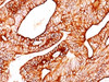 Formalin-fixed, paraffin-embedded human colon carcinoma stained with Cytokeratin 5/8 antibody (SPM268) .