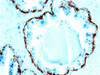 Formalin-fixed, paraffin-embedded human prostate carcinoma stained with Basic Cytokeratin antibody (SPM591) .