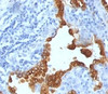 Formalin-fixed, paraffin-embedded human lung carcinoma stained with Cytokeratin 8 + 18 antibody (SPM141) .
