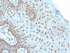 Formalin-fixed, paraffin-embedded human cervical carcinoma stained with c-Myc antibody (MYC275) .