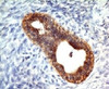 Formalin-fixed, paraffin-embedded human colon carcinoma stained with E-Cadherin antibody (CDH1/1525) .