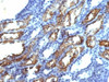 IHC testing of FFPE human renal cell carcinoma with IFN gamma antibody (clone IFNG/466) . Required HIER: boil tissue sections in 10mM Tris with 1mM EDTA, pH 9.0, for 10-20 min.