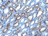 IHC testing of FFPE human renal cell carcinoma with IFN gamma antibody (clone IFNG/466) . Required HIER: boil tissue sections in 10mM Tris with 1mM EDTA, pH 9.0, for 10-20 min.