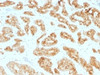 IHC testing of FFPE human prostate carcinoma with AMACR antibody (clone AMACR/1723) . HIER: steam sections in pH6, 10mM citrate buffer for 10-20 min.