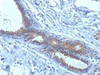 IHC testing of FFPE human breast carcinoma tissue with BRCA1 antibody (clone BRCA1/1398) . HIER: boil tissue sections in 10mM citrate buffer, pH 6.0, for 10-20 min.