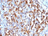 IHC testing of FFPE human melanoma stained with MART-1 antibody. HIER: steam sections in 10mM citrate buffer, pH 6.0, for 10-20 min.