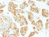 IHC testing of FFPE human prostate carcinoma with CD44v9 antibody (clone CD44v9/1459) . Required HIER: steam sections in pH6 citrate buffer for 10-20 min.