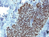 IHC testing of FFPE human prostate carcinoma with FOXA1 antibody (clone FOXA1/1514) . HIER: boil sections in 10mM Tris with 1mM EDTA, pH9, for 10-20 min.