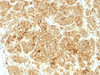 IHC testing of FFPE human renal cell carcinoma and EpCAM antibody. Required HIER: steam sections in pH6 citrate buffer for 10-20 min.