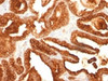 IHC testing of human prostate carcinoma with PSAP antibody (clone SPM312) . Required HIER: boil tissue sections in 10mM citrate buffer, pH 6, for 10-20 min followed by cooling at RT for 20 min.