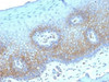 IHC testing of FFPE human cervical carcinoma with Thrombomodulin antibody (clone THBD/1782) . HIER: boil tissue sections in 10mM Tris buffer with 1mM EDTA, pH 9, for 10-20 min followed by cooling at RT for 20 min.