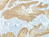 IHC testing of FFPE human lung squamos cell carcinoma with Desmoglein 3 antibody (clone DSG3/1535) . Required HIER: boil tissue sections in 10mM citrate buffer, pH 6, for 10-20 min.