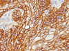 IHC testing of FFPE human lung squamous cell carcinoma with EGF Receptor antibody (clone GFR/1708) . Required HIER: boiling tissue sections in 10mM citrate buffer, pH 6, for 10-20 min.