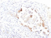 IHC testing of FFPE human lung carcinoma with Lewis y antibody (clone LWY/1463) . Required HIER: boil tissue sections in 10mM citrate buffer, pH 6, for 10-20 min.