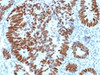 IHC testing of FFPE human colon carcinoma with p53 antibody. Required HIER: boil tissue sections in 10mM citrate buffer, pH 6, for 10-20 min.