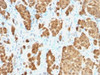 IHC testing of FFPE human melanoma with recombinant S100B antibody (clone S100B/1706R) . HIER: steam sections in 10mM citrate buffer, pH 6.0, for 10-20 min.