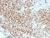IHC testing of FFPE Ewings sarcoma with NKX2.2 antibody (clone NX2/1523) . HIER: steam sections in 10mM citrate buffer, pH 6.0, for 10-20 min.