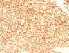 IHC testing of FFPE Ewings sarcoma with NKX2.2 antibody (clone NX2/1524) . HIER: steam sections in 10mM citrate buffer, pH 6, for 10-20 min.