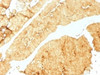 IHC testing of FFPE human colon with Villin antibody (clone VIL1/1325) . Required HIER: boil tissue sections in 10mM citrate buffer, pH 6, for 10-20 min followed by cooling at RT for 20 min.