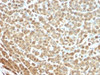 IHC testing of FFPE human melanoma stained with S100A antibody (clone S1-61) . Required HIER: boil tissue sections in 10mM citrate buffer, pH 6, for 10-20 min followed by cooling at RT for 20 min.
