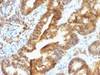 IHC testing of FFPE human colon carcinoma with TDP2 antibody (clone TDP2/1258) . Required HIER: boil tissue sections in 10mM Tris with 1mM EDTA, pH 9, for 10-20 min followed by cooling at RT for 20 min.