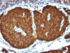 IHC testing of FFPE human pheochromocytoma with NSE antibody (clone ENO2/1375) . Required HIER: boil sections in 10mM citrate buffer, pH6, for 10-20 min.