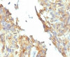 IHC testing of FFPE ovarian carcinoma and Alkaline Phosphatase antibody (KSUL-1) . Required HIER: boil tissue sections in 10mM Tris with 1mM EDTA, pH 9, for 10-20 min followed by cooling at RT for 20 min.