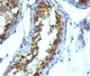 IHC testing of FFPE testicular carcinoma and Alkaline Phosphatase antibody (KSUL-1) . Required HIER: boil tissue sections in 10mM Tris with 1mM EDTA, pH 9, for 10-20 min followed by cooling at RT for 20 min.