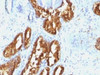 IHC testing of human prostate carcinoma with PSAP antibody (clone ACCP/1338) . Required HIER: boil tissue sections in 10mM citrate buffer, pH 6, for 10-20 min followed by cooling at RT for 20 min.
