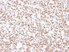 IHC testing of FFPE human thyroid carcinoma with PAX8 antibody (clone PAX8/1492) . Required HIER: boil tissue sections in 10mM Tris buffer with 1mM EDTA, pH 9, for 10-20 min followed by cooling at RT for 20 minutes.