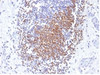 IHC testing of FFPE human urothelial carcinoma with PAX8 antibody (clone PAX8/1492) . Required HIER: boil tissue sections in 10mM Tris buffer with 1mM EDTA, pH 9, for 10-20 min followed by cooling at RT for 20 minutes.