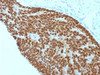 IHC testing of FFPE human colon carcinoma with CDX2 antibody (clone CDX2/1690) . Required HIER: boil sections in 10mM citrate buffer, pH6, for 10-20 min.