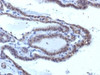 IHC testing of FFPE human thyroid carcinoma with TSHR antibody (clone SPM223) . Required HIER: boil tissue sections in 10mM Tris with 1mM EDTA, pH 9, or 10mM citrate buffer, pH 6, for 10-20 min followed by cooling at RT for 20 min.