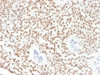 IHC testing of FFPE human bladder carcinoma with FOXA1 antibody (clone FOXA1/1241) . HIER: boil sections in 10mM Tris with 1mM EDTA, pH9 for 10-20 min followed by cooling at RT for 20 min.