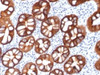 IHC testing of FFPE human colon carcinoma with recombinant EpCAM antibody (clone rMOC-31) . Required HIER: boil tissue sections in 10mM citrate buffer, pH 6, for 10-20 min followed by cooling at RT for 20 min.
