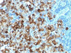 IHC testing of FFPE human melanoma with recombinant gp100 antibody (clone PMEL/1825R) . Required HIER: boil tissue sections in 10mM citrate buffer, pH 6, for 10-20 min followed by cooling at RT for 20 min.