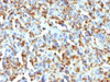 IHC testing of FFPE human histiocytoma with Factor XIIIa antibody (clone F13A1/1683) . Required HIER: boil tissue sections in 10mM citrate buffer, pH 6, for 10-20 min.
