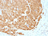 IHC testing of FFPE human melanoma with S100A1 antibody (clone S100A1/1942) . Required HIER: steam sections in 10mM citrate buffer, pH 6, for 10-20 min followed by cooling.