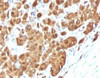 IHC testing of FFPE human melanoma with S100B antibody (clone PS1B1-1) . Required HIER: boil tissue sections in 10mM citrate buffer, pH 6, for 10-20 min followed by cooling at RT for 20 min.