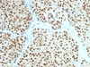 IHC testing of FFPE human melanoma with SOX10 antibody (clone SOX10/991) . Required HIER: boil tissue sections in 10mM citrate buffer, pH 6, for 10-20 min followed by cooling at RT for 20 min.