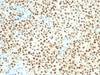 IHC testing of FFPE human melanoma with SOX-10 antibody (clone SOX10/1074) . Required HIER: boil tissue sections in 10mM citrate buffer, pH 6, for 10-20 min followed by cooling at RT for 20 min.