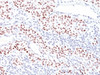 IHC: Formalin-fixed, paraffin-embedded human bladder carcinoma stained with TP53 antibody (TRP/816) . Required HIER: boil tissue sections in 10mM Citrate buffer, pH 6.0, for 10-20 min followed by cooling at RT for 20 min.