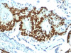 IHC testing of FFPE human colon carcinoma with recombinant p53 antibody (clone TP53/1799R) . Required HIER: boil tissue sections in 10mM citrate buffer, pH 6, for 10-20 min.