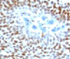 IHC staining of human colon carcinoma with p53 antibody (CTA53-1) .