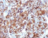 IHC testing of FFPE breast carcinoma and MUC-1 antibody (clone MCN01-1) .