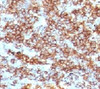 IHC testing of CD45RB antibody and FFPE human lymphoma (clone CDLA45RB-1) .