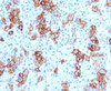 IHC testing of FFPE human Hodgkin's lymphoma and CD30 antibody (CDLA30-1) .