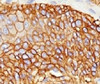IHC testing of lung squamous cell carcinoma stained with EGFR antibody (ERB59-1) .
