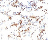 IHC testing of FFPE human colon carcinoma and p27Kip1 antibody (clone KIP27-1) .